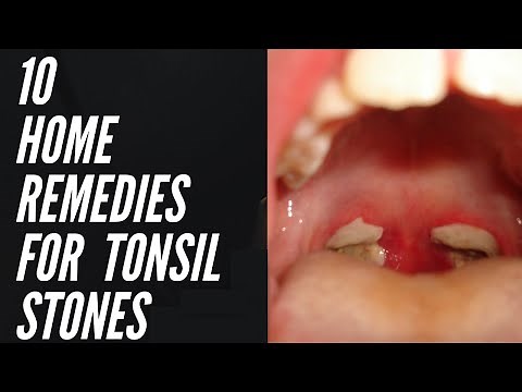 10 Home Remedies For Tonsil Stones That Work Fast | How To Get Rid of Tonsil Stones at Home