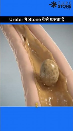 How does stone gets stuck into the ureter #rirs #urology