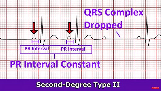 Second-Degree Type II AV Heart Block (Mobitz II) ECG Review