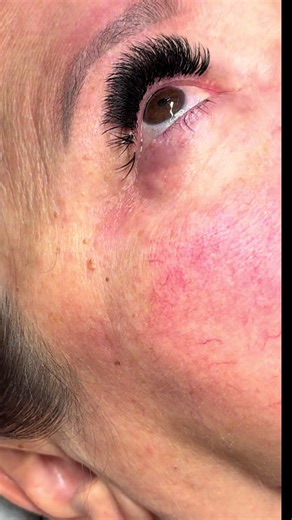 Fluid-filled cyst (hydrocystoma) \t•\tSmall, clear, bubble-like bump \t•\tPops easily with clear liquid \t•\tOften caused by blocked sweat glands \t•\tVery common around eyelids