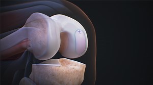 BioUni® OATS® Technique for Femoral Condyle Osteochondral Defect Restoration