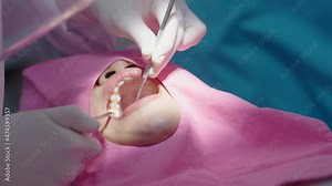 Female dentist and assistant extracting a patient's tooth in a treatment room at a dental clinic. Concept of oral health treatment, root canal treatment, oral surgery