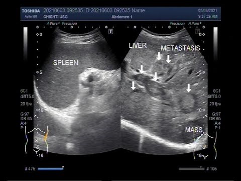 Multiple Hepatic metastases.