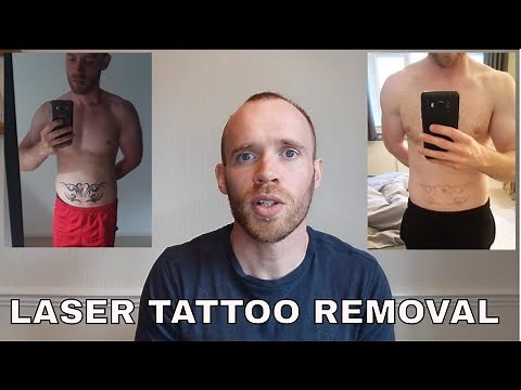 Laser Tattoo Removal - Sessions 10-12 Update (Final Outcome!)