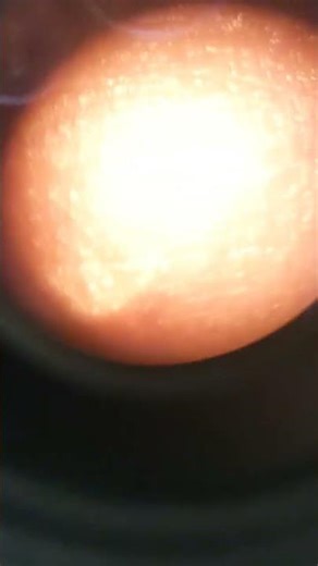 Slow movement (after blinking) of RGP(rigid Gas Permeable) lens