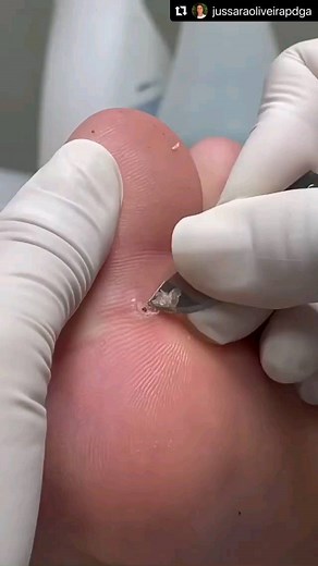 MyCern Beauty & Anti-Aging on Instagram: "Do you know what TUNGIASIS is? Credit: @jussaraoliveirapdga . . Disclaimer: No copyright infringement intended. All credit goes to the rightful owners. Please DM for credits or removal. . . #footcare #feet #pedicure #podiatry #podiatrist #foot #foothealth #footpain #skincare #medicalpedicure #spapedicure #footcaretips Follow @beauty_medical_devices, @skincare_news @skincare_doctors ➡️ for additional skincare & beauty hacks, tips, and more! #skinlove"