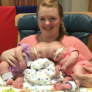 Unique twins born attached at the head: See how they look today, 2 years after the separation