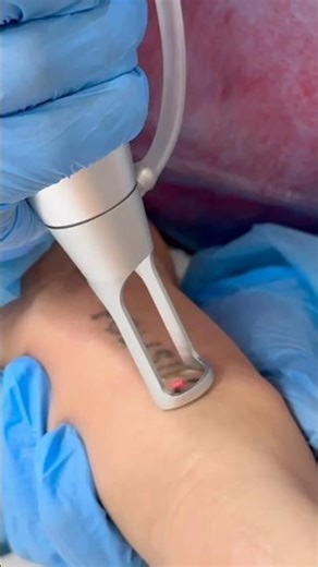 Se você teve coragem para fazer uma tatuagem de que se arrependeu, tenha coragem para removê-la.