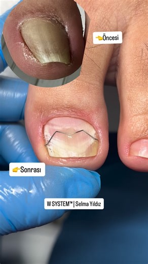 Selma Yıldız | El Ayak Bakımı on Instagram: "W SYSTEM™ Ortoniksi Uygulaması – Unguis Incarnatus Kişiye Özel Tırnak Yönlendirme ve Yük Dengeleme Sistemi W SYSTEM™, Selma Yıldız tarafından geliştirilen; tırnak plağının biyomekaniğini esas alan, kontrollü ve kademeli düzeltme prensibiyle çalışan ortoniksik bir sistemdir. Ortoniksi tel uygulamasında 0,4 mm ortoniksi tel kullanılır. Distalden yerleştirilen yaylı mekanizma sayesinde, tırnağın problemli kenarı kontrollü ve dengeli şekilde yönlendiriler