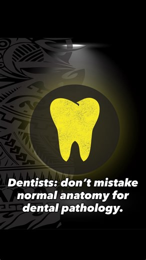 Jonathan Wong | The mental foramen can be confused for tooth infection. Testing vitality of the tooth with simple thermal stimulation is one easy way to... | Instagram