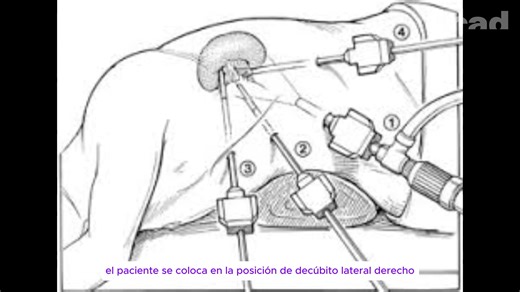 ESPLENECTOMIA LAP ANEURISMAS