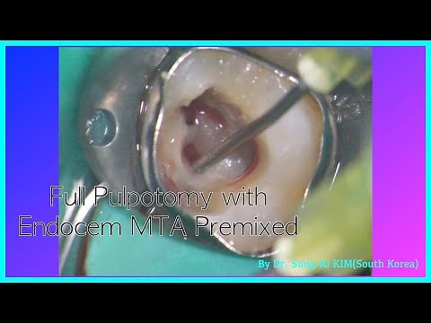 Full pulpotomy as a vital pulp therapy on permanent tooth with Endocem MTA premixed