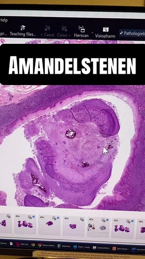 Antwoorden op @rrrrroos tonsilstenen; komt veel voor en is meestal geen probleem