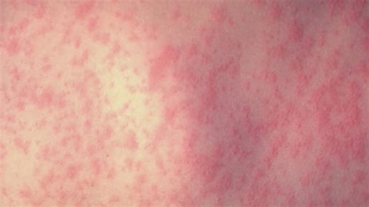 Coconino County confirms first measles case of 2026