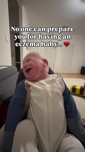 Eczema in Black Babies: Causes & Treatment