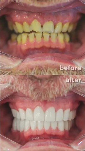 Zirconia Crowns Before and After