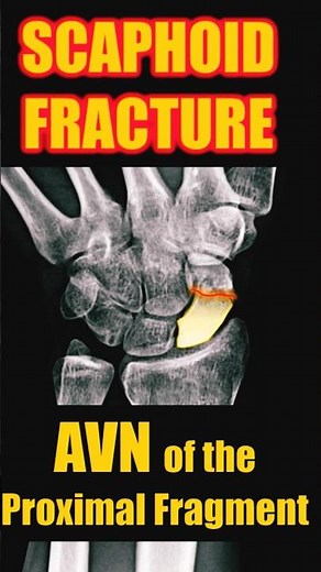 Fracture of the Scaphoid with Avascular Necrosis #radiology #doctor #trauma