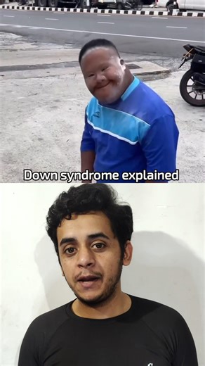Down syndrome explained