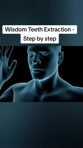 Wisdom Teeth Extraction - Step by step Wisdom tooth extraction is a common surgical procedure to remove one or more wisdom teeth, located at the back corners of the mouth. These are found on the top and bottom and usually appear between the ages of 17 and 25. The third molar, better known as wisdom tooth, is the last tooth to appear in humans. In some cases there is not enough room for wisdom teeth to emerge or develop normally. Wisdom teeth do not cause problems, however, if there is not enough