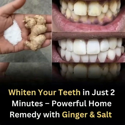 Whiten Your Teeth in Just 2 Minutes – Powerful Home Remedy with Ginger & Salt ✨🦷 | Video Feed