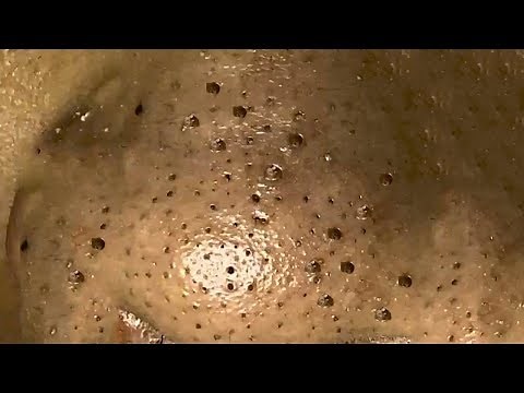 How To Remove Very Deep and Dark Blackhead