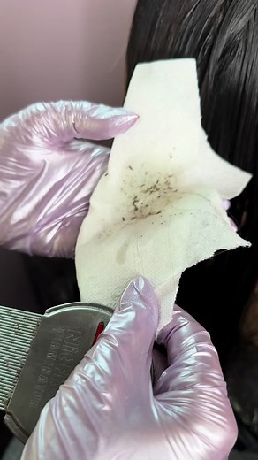 Hundreds on bugs 🐜 #fyp #FY #FORYOUPAGE #piojos #theliceangels #viralvideo #lice #licetok #headlice #TEXAS