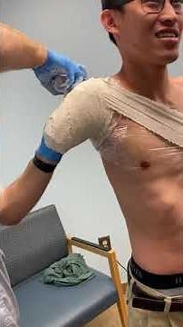 Transhumeral Prosthesis Casting Process