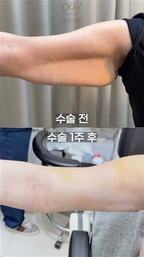 #팔거상 #brachioplasty #지방흡입 #팔지방흡입 #팔리프팅