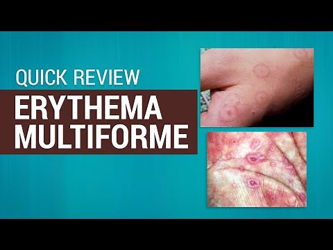 Erythema Multiforme & Steven-Johnsons Syndrome - What are these and their treatments? Learn Quickly!