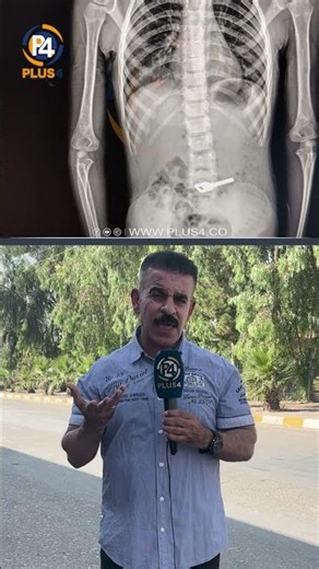کلیل لەگەدەی منداڵێکی کەرکوکیدایە و دەبێت نان زۆر بخوات تا دەرچێت