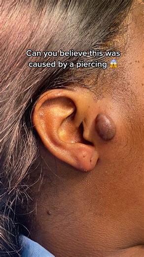 Do all piercings cause Keloid’s? NO! ⬆️ keloids are know to be genetic, however you should always look after your piercings. Will it grow back? ⬆️ There is always a chance if reoccurrence. However with the correct excision technique in combination with steroid injections, the chance of reoccurrence is low. We are based in London and Birmingham, UK if you need our help. ❤️ #keloidremoval #keloid #keloidawareness #scar #piercing #plasticsurgery #skincare #london #dermotology #keloidseries