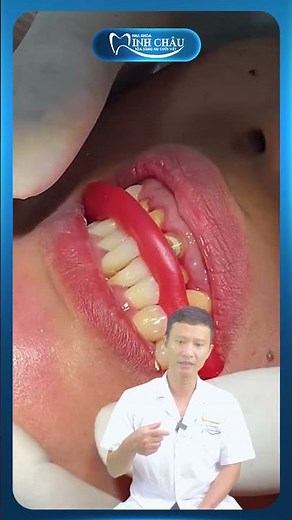 The Process of Dental Impression for Porcelain Crowns | Dr. Yen