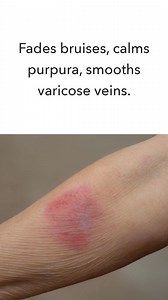 "Helichrysum balm is the best product I’ve found for reducing and recovering from purpura and bruising on the hands and arms. It also helps reduce the appearance of varicose and spider veins in the legs and ankles. I was taking 1/4 cup of olive oil a day, even bathing in it to reduce the ugly purple marks on my hands and arms. Helichrysum works fast and leaves skin feeling soft, supple and hydrated. I had seen 2 doctors about the purpura problem neither of which had a solution. After starting He