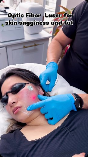 “endolaser” for skin sogginess, they are often talking about endolaser lipolysis or laser-assisted skin tightening, a minimally invasive cosmetic procedure. This treatment uses a laser beneath the skin’s surface (hence “endo”) to stimulate collagen production and promote skin tightening, often in areas like the jawline, neck, arms, or thighs. | Ariel Sotolongo