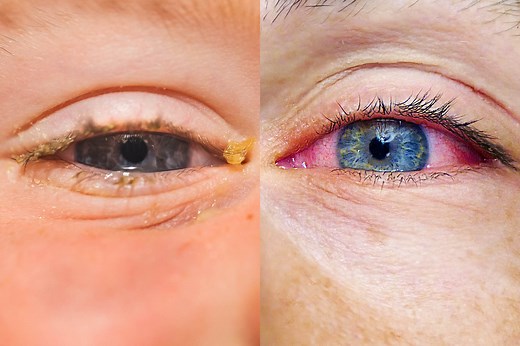 Allergies or Pink Eye: Here’s How to Tell the Difference