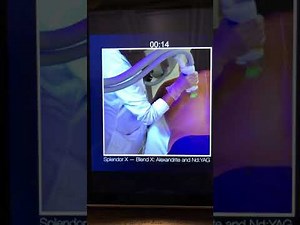 Lumenis SPLENDOR X Fast, Pain Free Laser Hair Removal for your patients call or text 410-627-9456