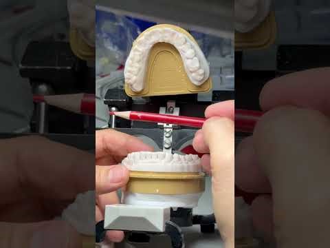 Starting new full mouth case!