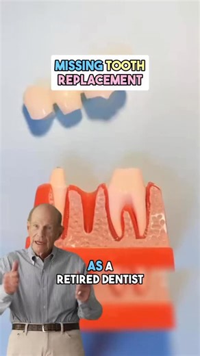 1K views · 11 reactions | What Happens When You Lose A Tooth? 醴 If you lost a tooth would you pick a bridge or an implant? Comment below and let me know which one you would choose and why! #dentistry #dental #smile #dentalcare #teeth | Wonderful Dental | Facebook