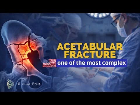 Acetabular fracture: when is it serious and requires surgery? | Orthopedics in 5 minutes