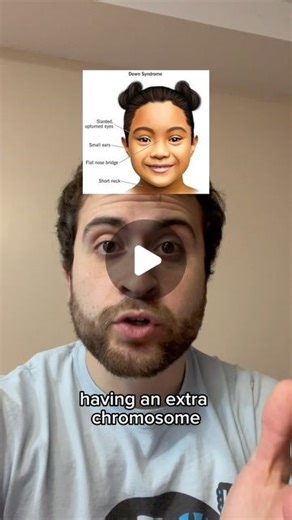 Med Dweeb | There are other milder forms caused by chromosomal translocation or mosaicism but this is the most common. Follow for more medical content!... | Instagram
