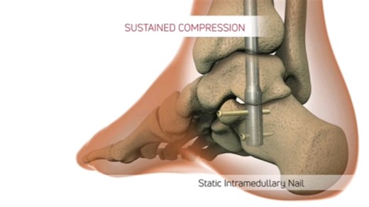DynaNail胫距跟关节弹性髓内钉固定术
