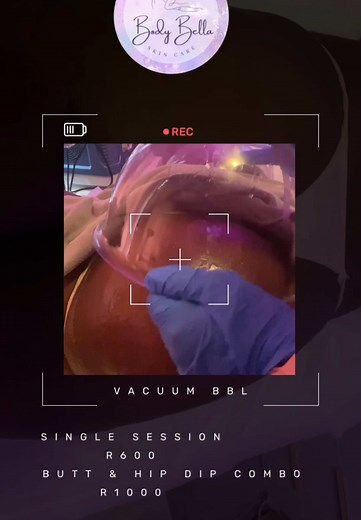 **Transform Your Curves with Our Butt Vacuum BBL Treatment! 🍑✨** Watch as our amazing client reveals her stunning results after her Butt Vacuum BBL cups are removed! **Benefits of the treatment:** - **Enhanced Volume:** Achieve that fuller, more rounded look! - **Non-Invasive:** A safer alternative to traditional surgeries. - **Quick Results:** Noticeable changes in just one session! - **Skin Tightening:** Helps improve skin elasticity and smoothness. - **Long-lasting Effects:** Enjoy your beau