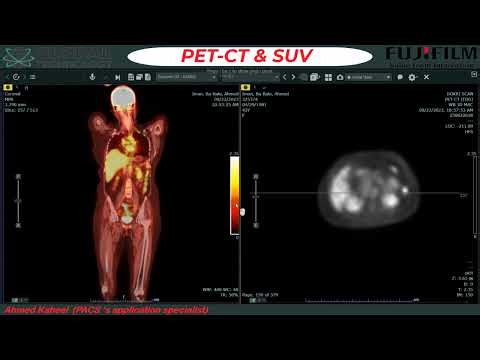 Fujifilm Synapse PACS Tutorial: PET-CT Fusion & SUV Measurement (Part 14)
