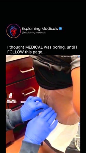 Medical | Health | Anatomy on Instagram: "In this close-up footage, a Purple Heart–decorated U.S. Army veteran documents the intense reality of undergoing a trial spinal cord stimulator implantation in his lower back. With gloved medical hands carefully inserting electrode leads beneath the skin, the video captures the raw, uncomfortable nature of a procedure designed to manage severe, long-term pain. A retired infantryman from Operation Enduring Freedom, he has already undergone spinal fusion s