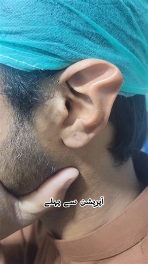 Stahl's Ear Deformity #foryoupage #fypシ゚ #otoplasty #prominentears #peshawar