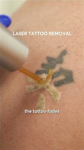 Laser Tattoo Removal Explained 🔥 Watch the Ink Disappear!
