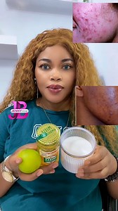 29K views · 450 reactions | How To Get Rid Of Acne Pimples!  #naturalremedy #HomeRemedy #everyone #viral #foryou #reelsfypシ | JENNY BLOG | Facebook