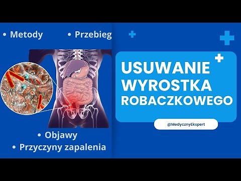 Wycięcie wyrostka robaczkowego: Diagnoza, Objawy i Leczenie