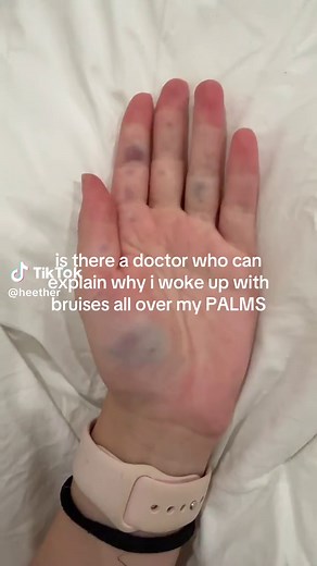Understanding Unexplained Bruises on Palms
