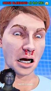 #ShareHow to Stop Nose Bleeding?😱